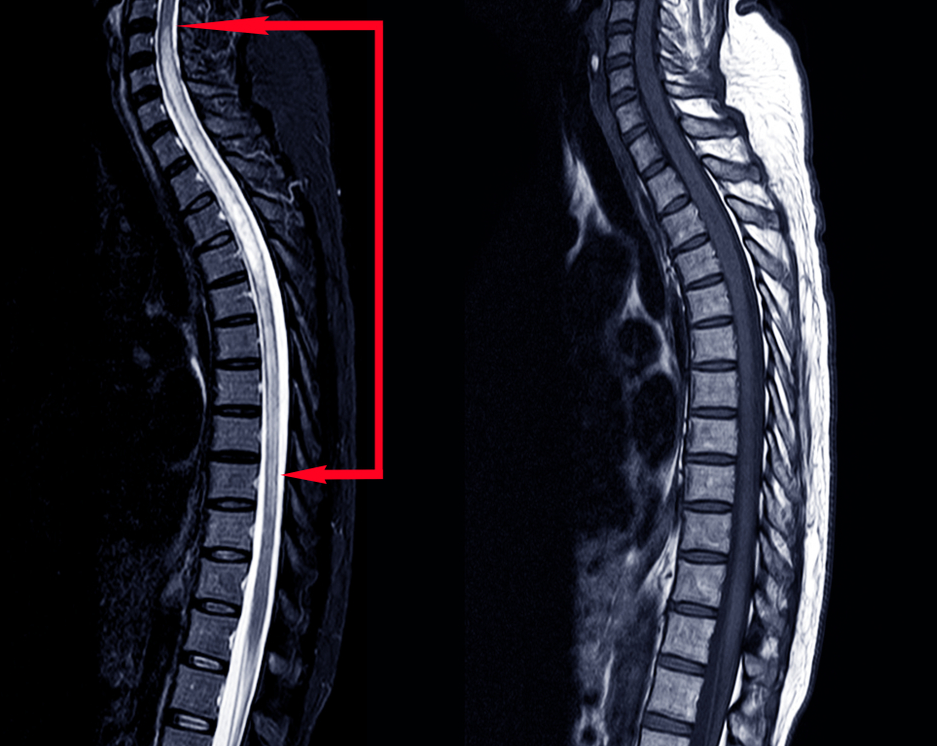 thoracic extension