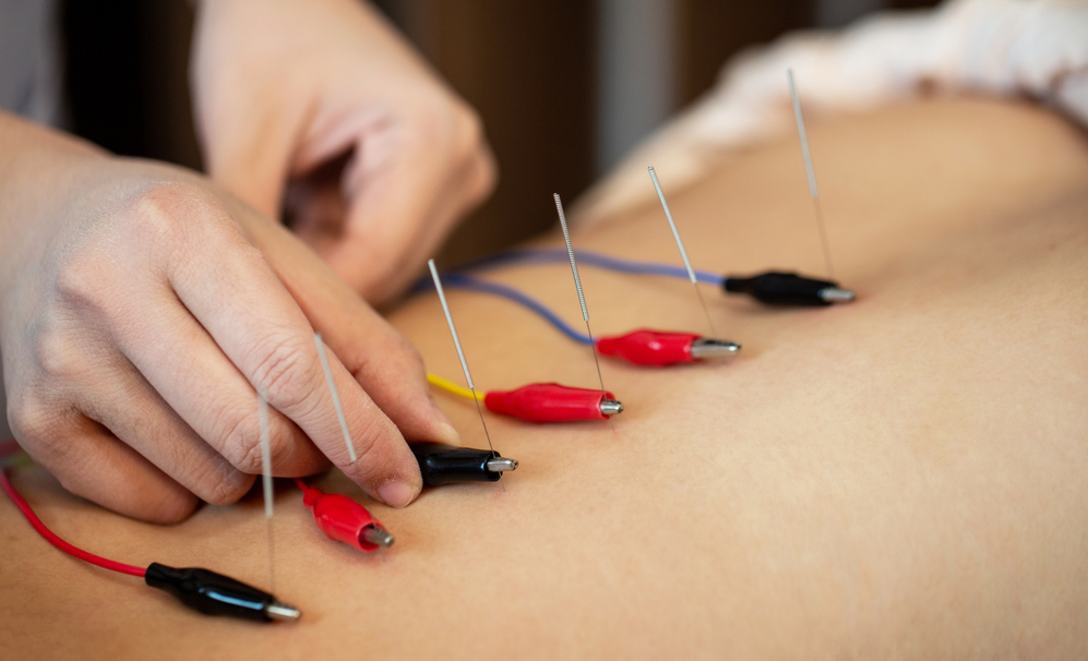 history of electroacupuncture